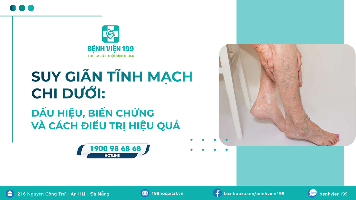 Suy giãn tĩnh mạch chi dưới: Dấu hiệu, biến chứng và cách điều trị hiệu quả