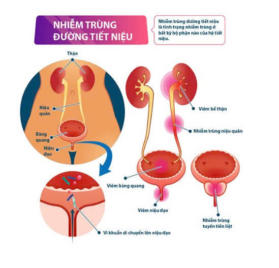 NHIỄM TRÙNG ĐƯỜNG TIẾT NIỆU Ở PHỤ NỮ MANG THAI